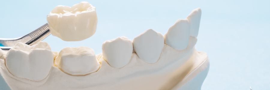 prothese-amovible-ou-implants-dentaires-que-choisir-dentiste-vincennes