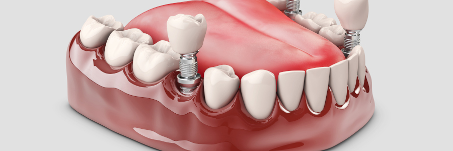 differents-types-de-protheses-sur-implants-dentiste-vincennes