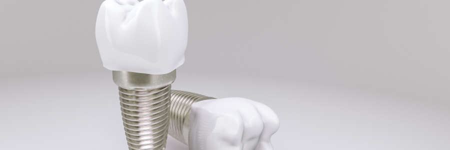 avantages-et-inconvenients-des-implants-dentiste-chateau-de-vincennes